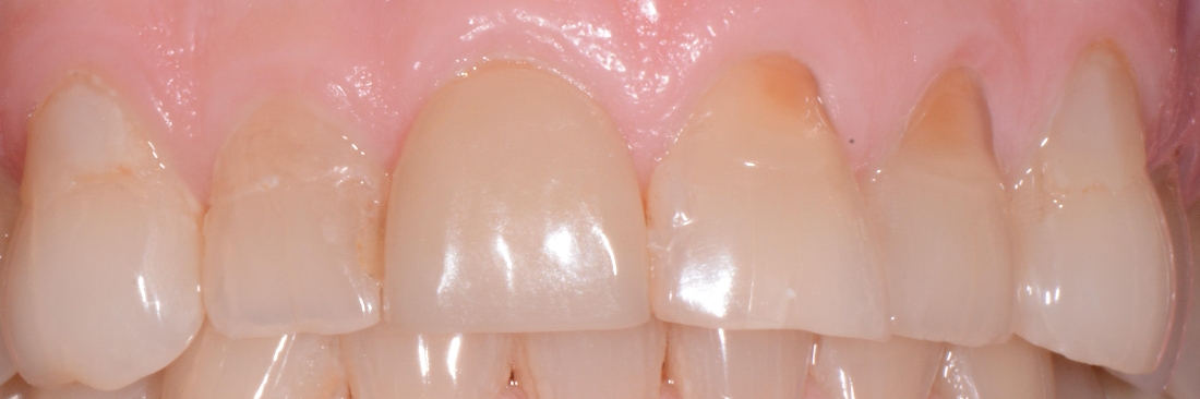 Worn teeth with old fillings and lost length