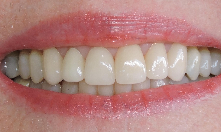 A-tragic-fall-turns-to-dental-masterpiece-After-Image