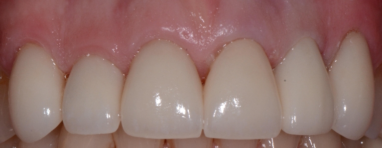 Treating-worn-teeth-After-Image