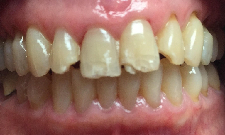 A-tragic-fall-turns-to-dental-masterpiece-Before-Image