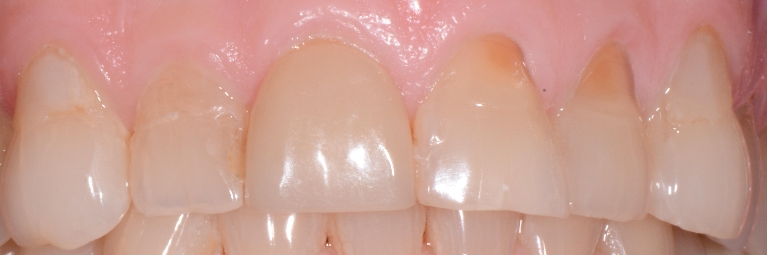 Treating-worn-teeth-Before-Image