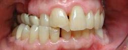 Broken Front Tooth 1