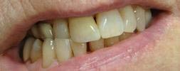 Broken Front Tooth 2