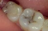 Composite Restoration 1