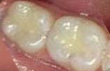 Composite Restoration 2