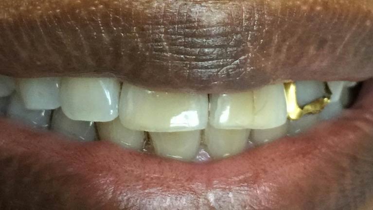 Gold Crown Becomes A Natural Tooth 1