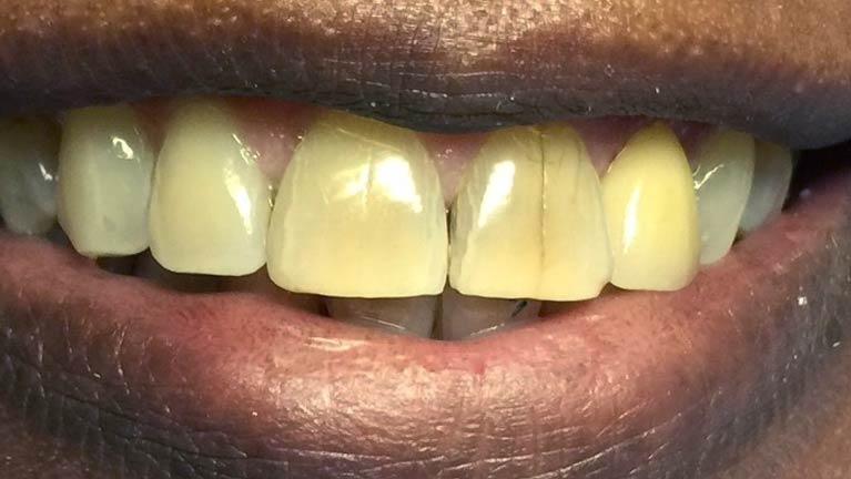 Gold Crown Becomes A Natural Tooth 2