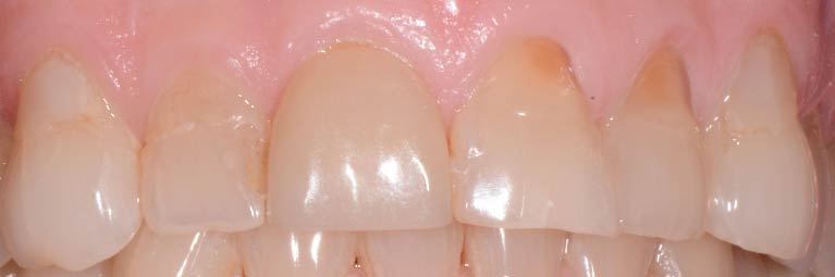 Treating Worn Teeth 1