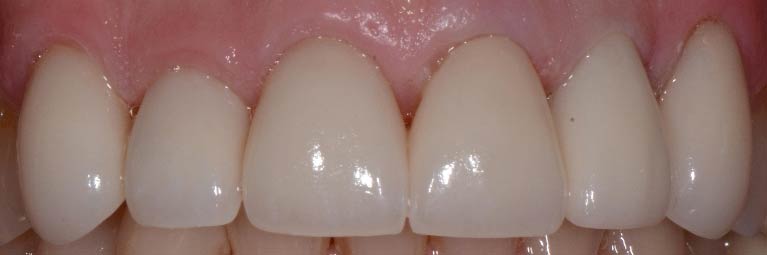 Treating Worn Teeth 2