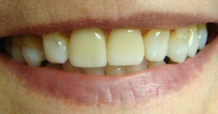 Veneers 2